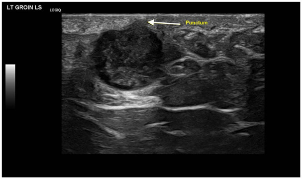 Hernia parte IX Ecografia tempo formacion.jpg